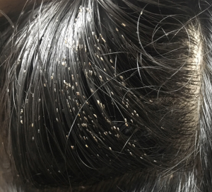 تفسير حلم القمل في الشعر للبنت