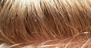 Lice in a dream in the hair