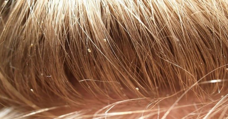 القمل في المنام في الشعر