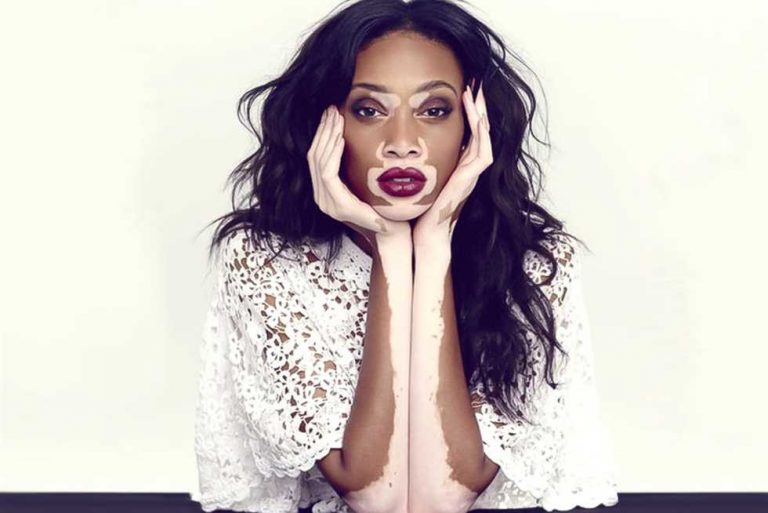 رؤية البهاق في المنام