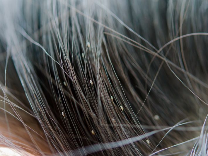 Що таке гниди в волоссі і як вони виглядають - секрети тлумачення снів