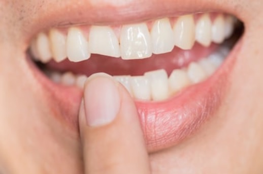 cracked tooth - اسرار تفسير الاحلام