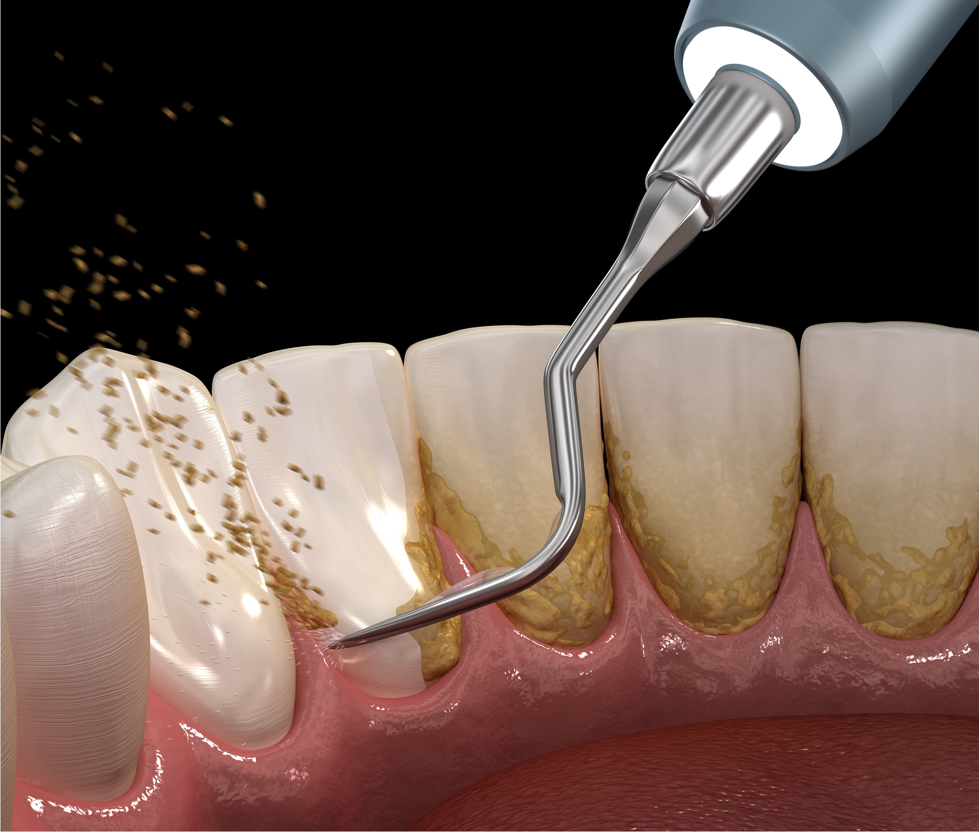  هي عملية تنظيف الاسنان من الجير - اسرار تفسير الاحلام
