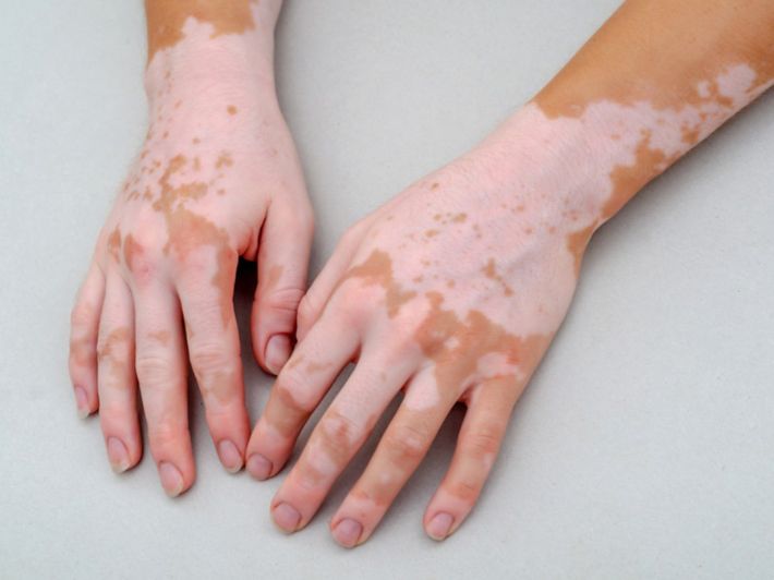 Výklad sna o vitiligu na ruke