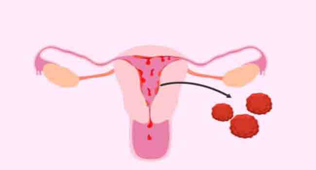 Gumpalan getih sajrone siklus menstruasi - rahasia interpretasi impen