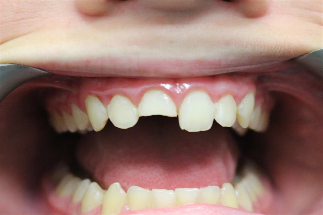 Tumačenje sna o zubu podijeljenom na dvije polovice