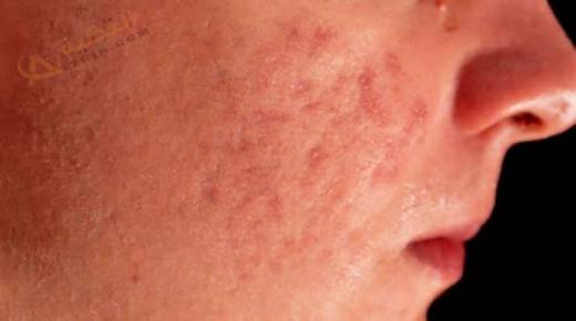 Cad é an léirmhíniú ar an aisling pimples facial?