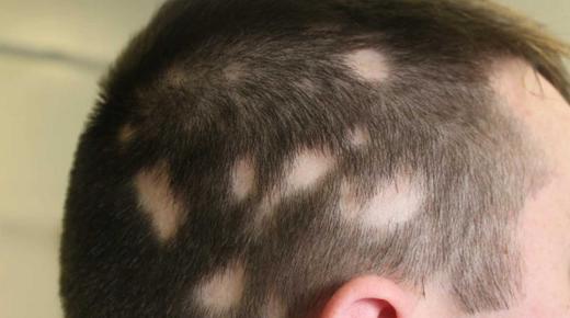 20 interpretasi sing paling penting kanggo ndeleng alopecia ing ngimpi dening Ibnu Sirin
