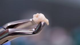 Mikä on Ibn Sirinin hampaanpoistounen tulkinta?