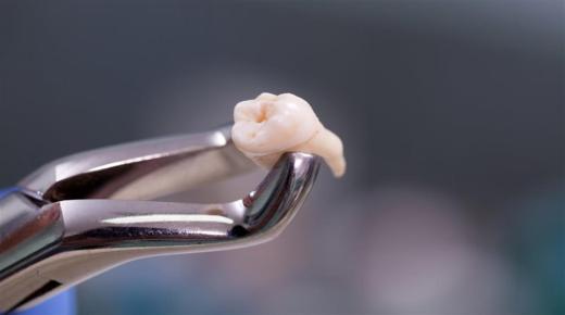 Aký je výklad sna o extrakcii zubov pre Ibn Sirina?