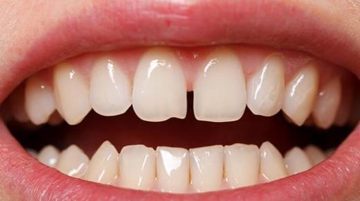 أهم 20 تفسير لرؤية الاسنان الامامية في المنام لابن سيرين