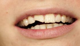 ما هو تفسير حلم تكسر الأسنان لابن سيرين؟