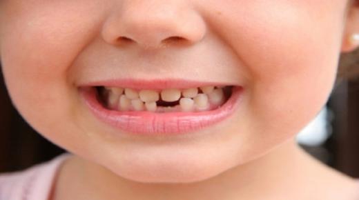ما هو تفسير حلم وقوع الأسنان لابن سيرين؟